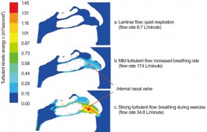 Assessment of Nasal Air Flow